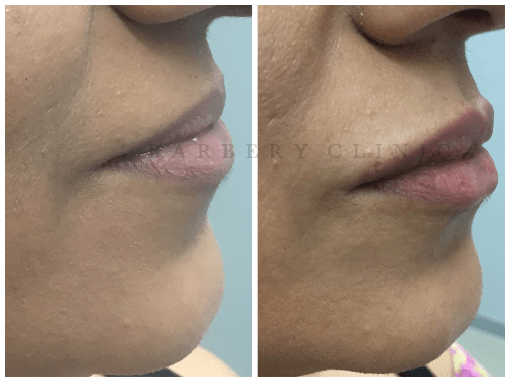 Subtiel Vollere Lippen